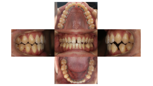 リンガル・正中離開の症例