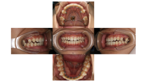 上顎前突・リンガルの症例