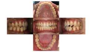リンガル・正中離開の症例