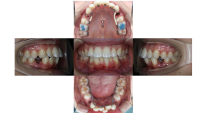 上顎前突・リンガルの症例