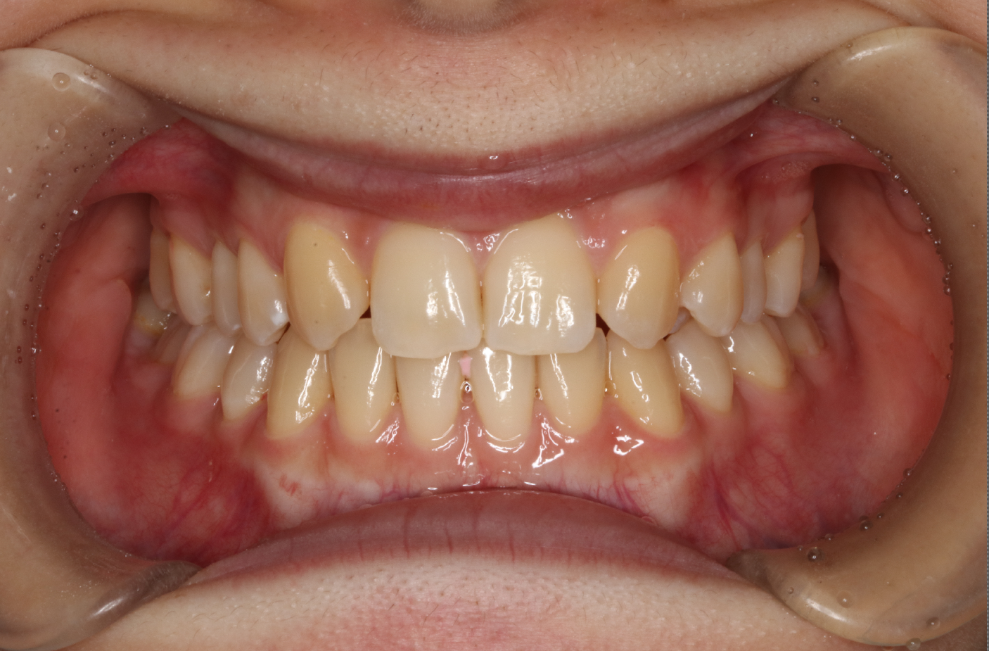 叢生・リンガル