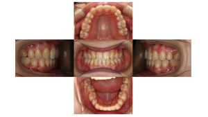 リンガル　叢生6