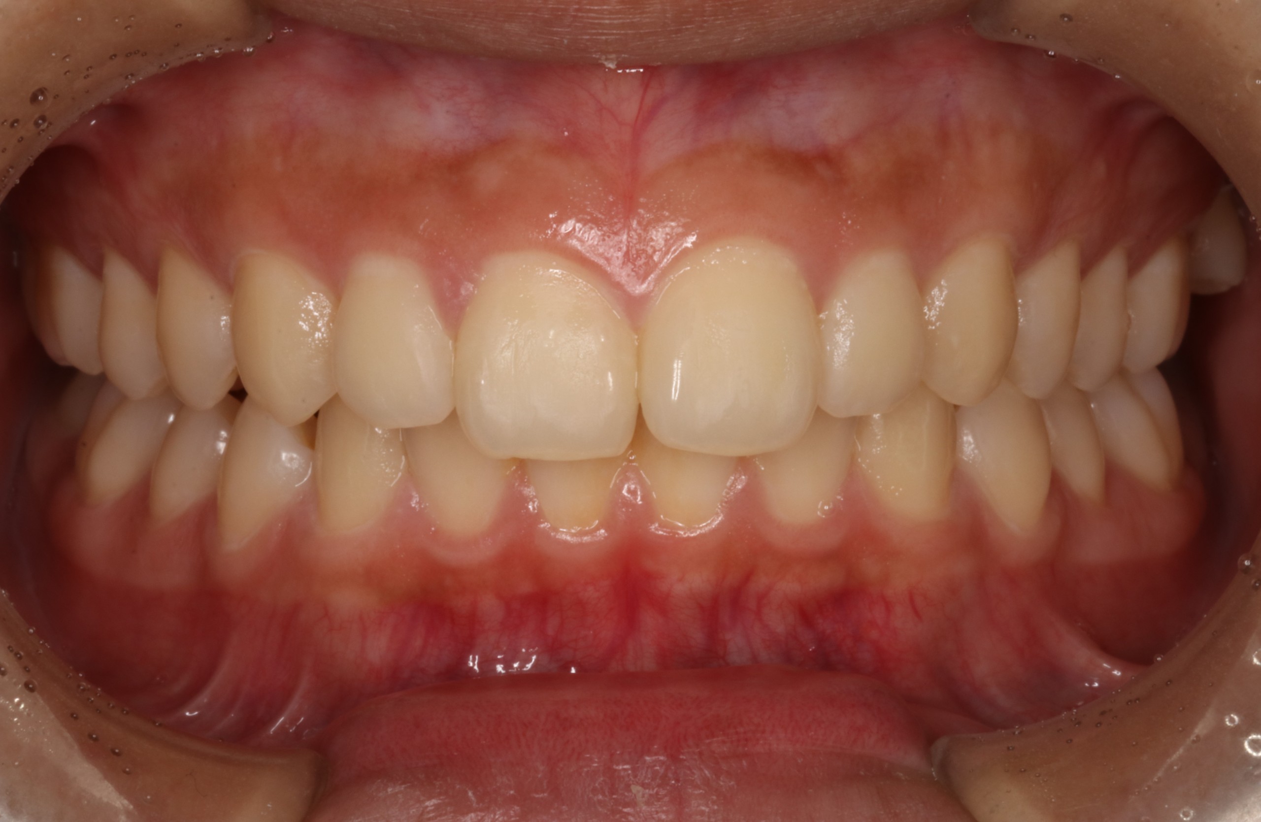 上顎前突・リンガルの症例