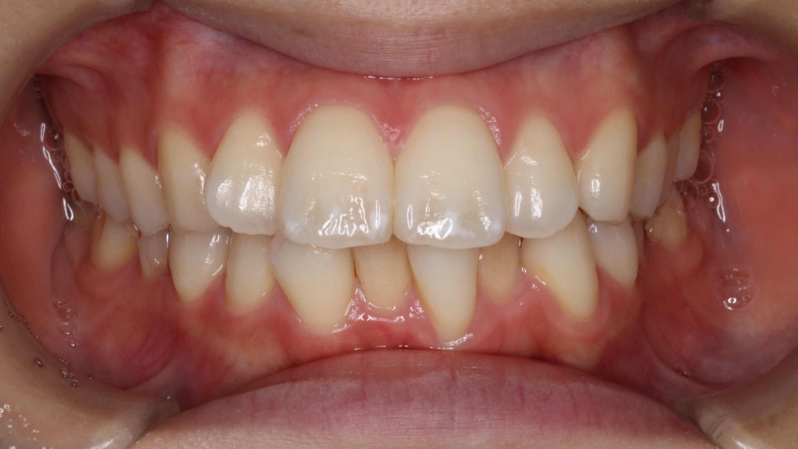 上顎前突・リンガルの症例