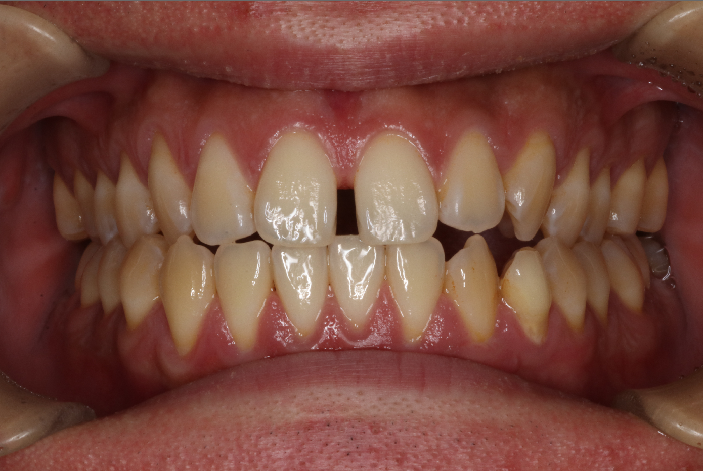 リンガル・正中離開の症例