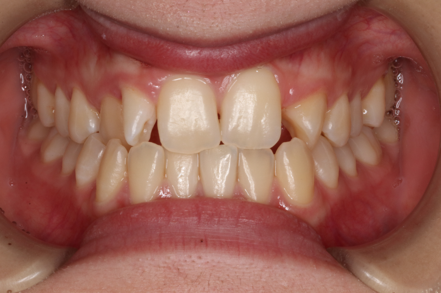 叢生・リンガル