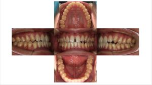 リンガル・正中離開の症例