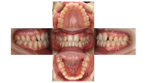 リンガル　叢生