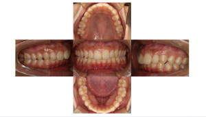 上顎前突・リンガルの症例