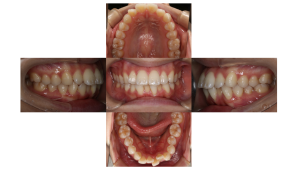 上顎前突・リンガルの症例