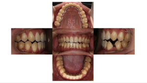 リンガル・正中離開の症例