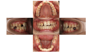 叢生・ハーフリンガルの症例