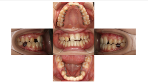 リンガル　叢生2