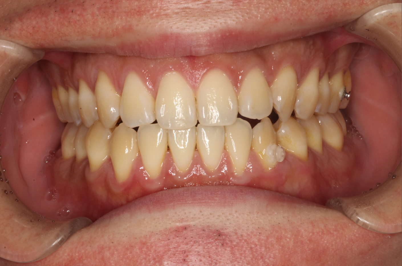 リンガル・正中離開の症例