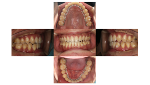 リンガル・正中離開の症例