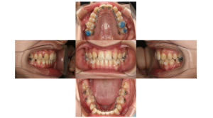 叢生・ハーフリンガルの症例