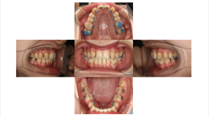 リンガル　叢生3