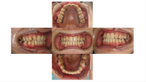 リンガル　叢生4