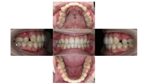 上顎前突・叢生・リンガルの症例