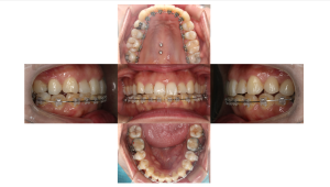 凸凹を改善したい・叢生・ハーフリンガル矯正の症例