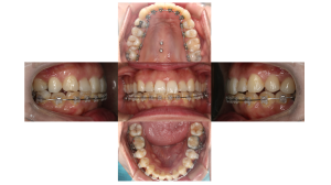 叢生・ハーフリンガルの症例