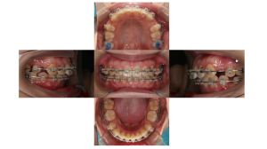 ラビアル・上顎前突・過蓋高校