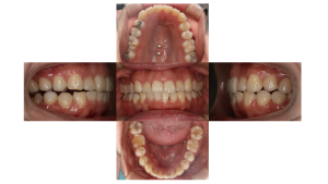 凸凹を改善したい・叢生・ハーフリンガル矯正の症例