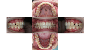 上顎前突・叢生・リンガルの症例