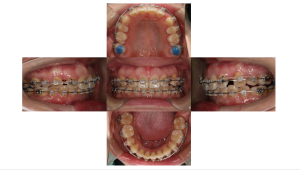 ラビアル・上顎前突・過蓋高校