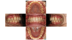 上顎前突・叢生・リンガルの症例