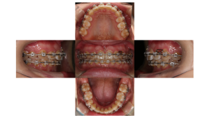 ラビアル・上顎前突・過蓋高校