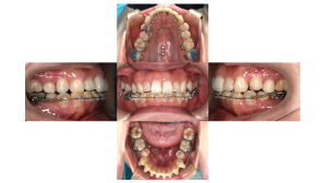 凸凹を改善したい・叢生・ハーフリンガル矯正の症例