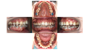 凸凹を改善したい・叢生・ハーフリンガル矯正の症例