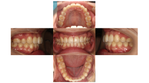 上顎前突・叢生・リンガルの症例