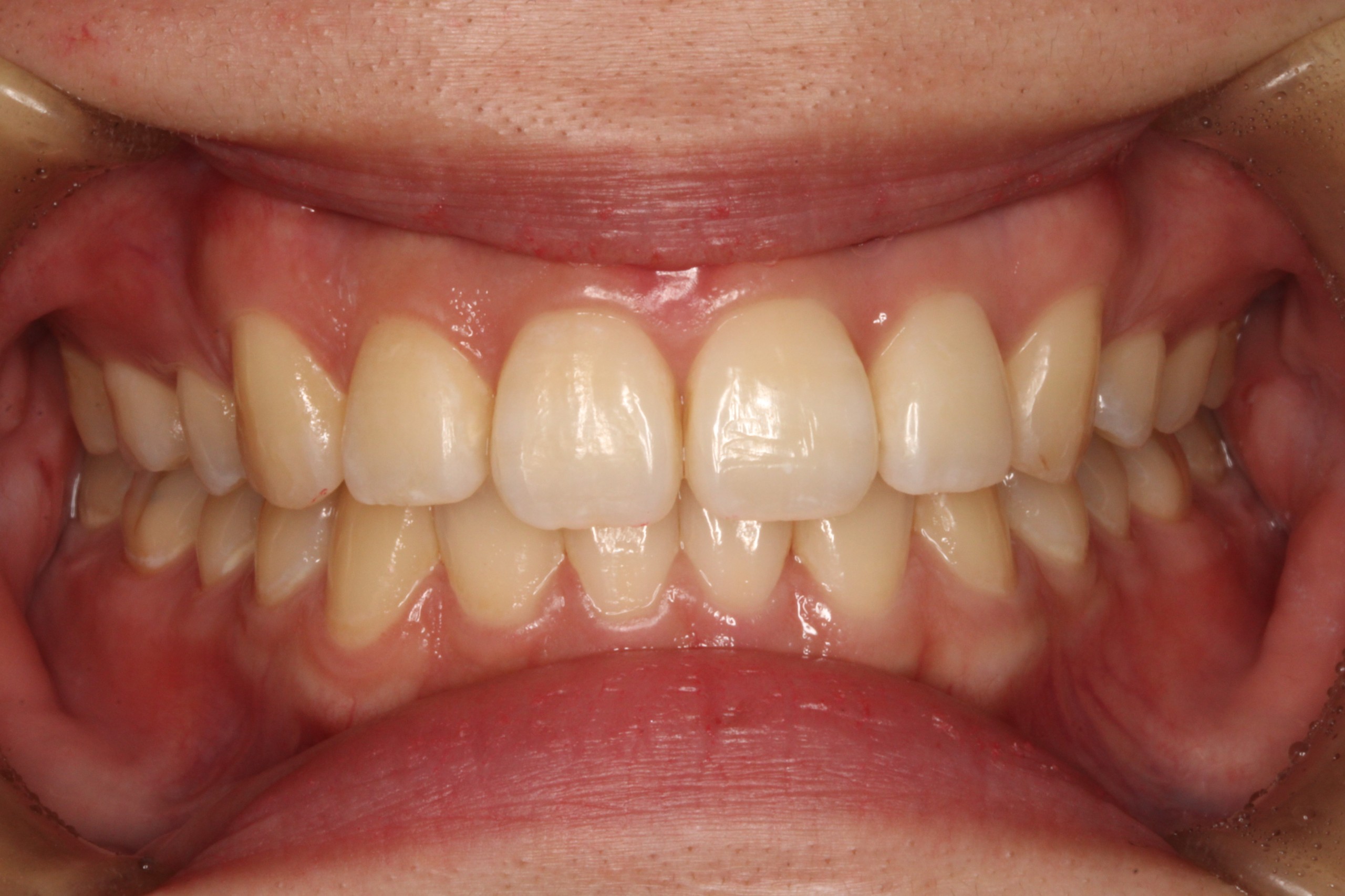 上顎前突・叢生・リンガルの症例