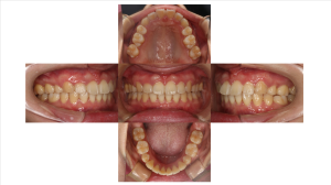 ラビアル・上顎前突・過蓋高校