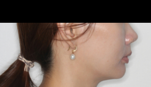 ラビアル・過蓋咬合・上顎前突