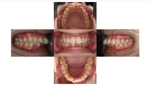 上顎前突・叢生・リンガルの症例