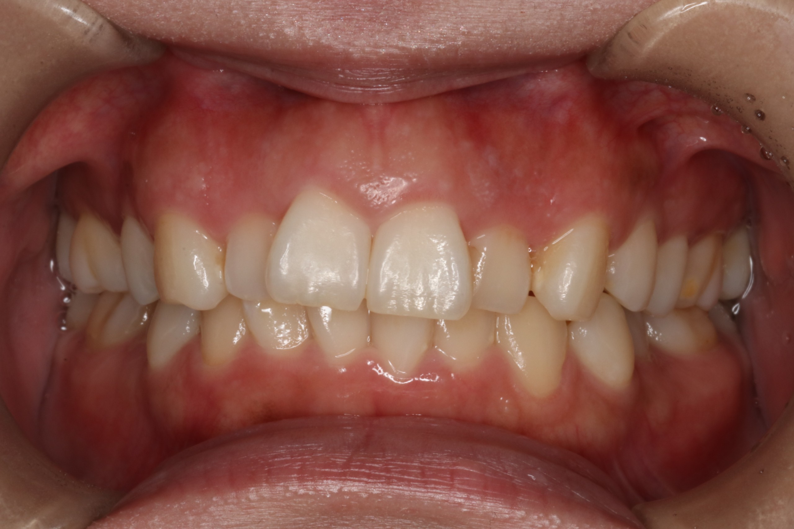 凸凹を改善したい・叢生・ハーフリンガル矯正の症例