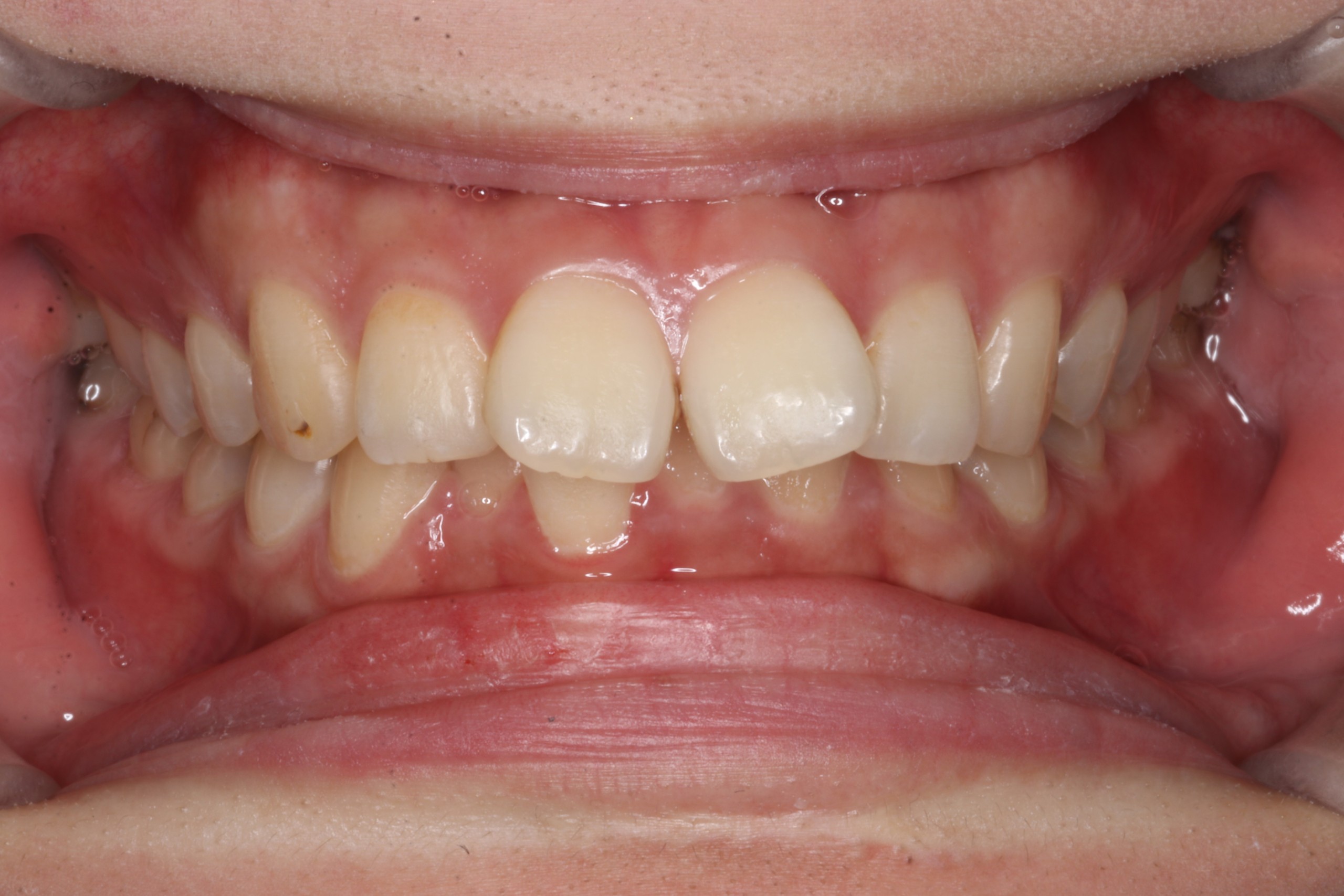 上顎前突・叢生・リンガルの症例