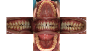 正中離開・リンガルの症例