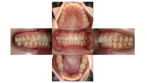 ラビアル・上顎前突・過蓋高校