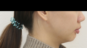 ラビアル・上顎前突・過蓋咬合