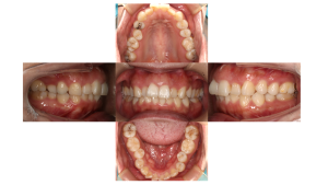 叢生・ハーフリンガルの症例