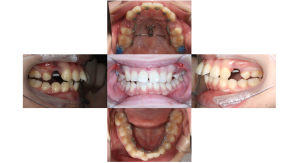 上顎前突・叢生・リンガルの症例