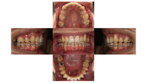 八重歯、叢生・ハーフリンガル矯正の症例