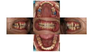 叢生・リンガル矯正の症例