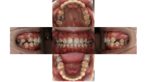 上顎前突・叢生・リンガルの症例