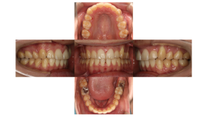 八重歯、叢生・ハーフリンガル矯正の症例