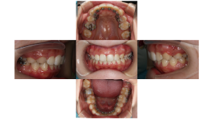 上顎前突・叢生・リンガルの症例